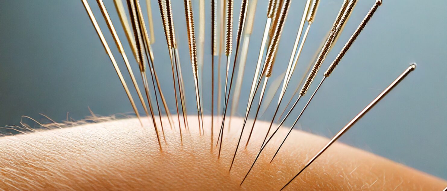 dry needling